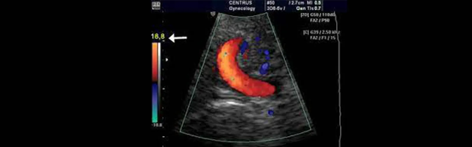 What is the Role of Color Doppler in Obstetric?